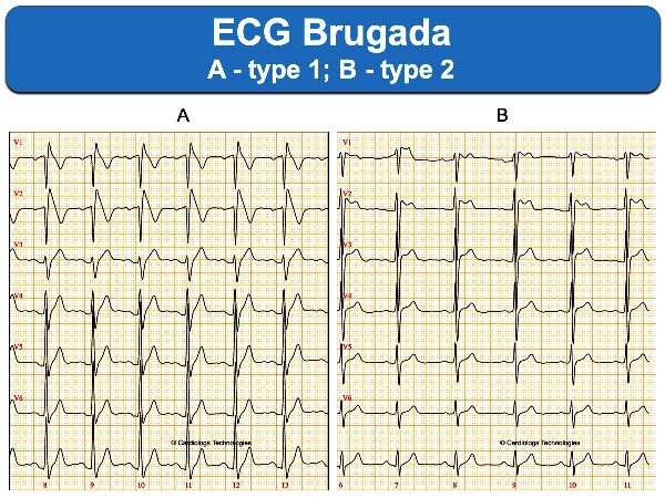 ECG Brugada