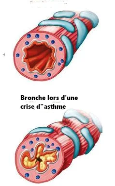 Bronches de l'asthmatique, œdème et bronchoconstriction