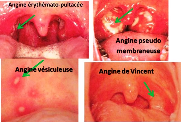 Amygdalite aiguë, semiologie et formes cliniques