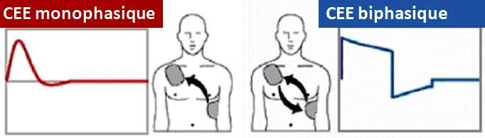 choc électrique externe biphasique