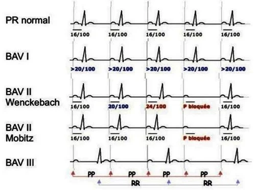 ECG, bradycardies et différents BAV diagnostic