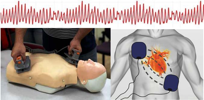 troubles du rythme, choc électrique externe