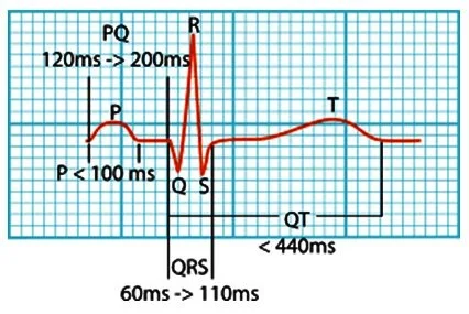 Tracé ECG, critères tachycardies et traitement