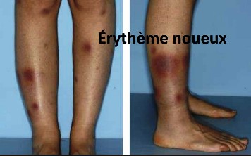 érythème noueux, streptocoque