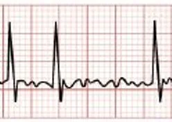 Fibrillation atriale, consensus
