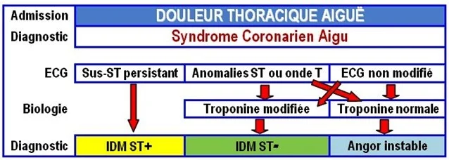 Algorithme, Diagnostic de douleur thoracique, SCA Algorithme, Diagnostic de douleur thoracique, SCA