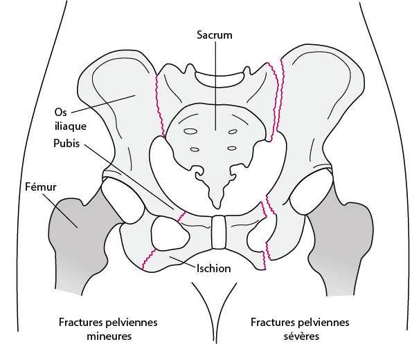 https://www.efurgences.net/images/sampledata/2022/pelvis.gif