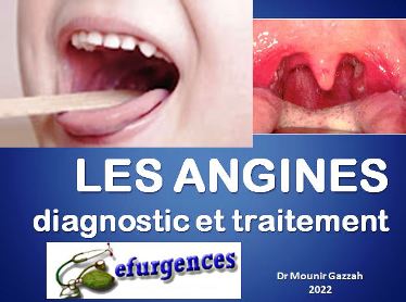 Les angines, diagnostic et traitement