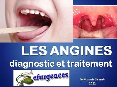 angines et pharyngites, traitement