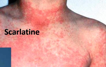 Scarlatine, érythème cutanée