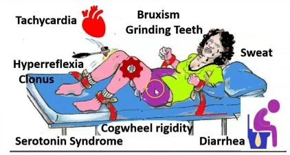 Toxidrome Sérotoninergique Toxidrome Sérotoninergique intoxication