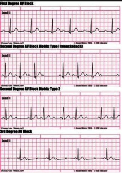 Différents types de bradycardies BAV