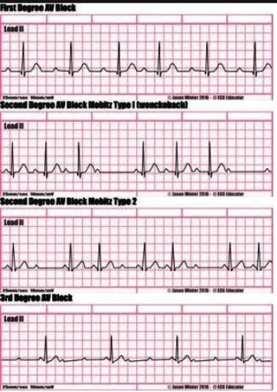 ECG, différents types de bradycardies et BAV, conduite à tenir