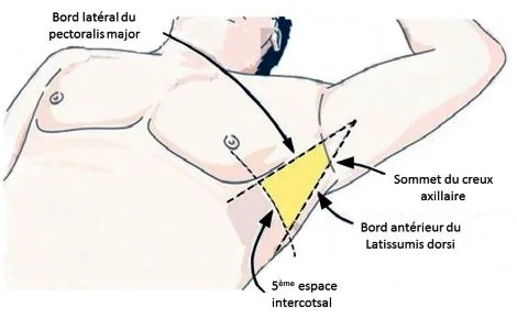 Ponction de pleurésie
