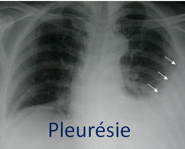 Épanchement pleural liquidien, recommandations 2023