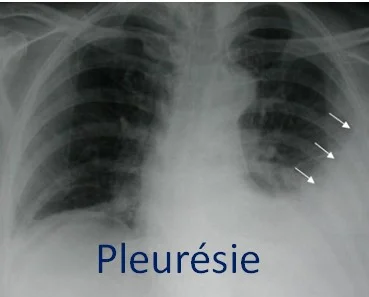 Radiographie de pleurésie