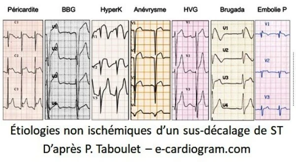 Sus décalage ST infarctus
