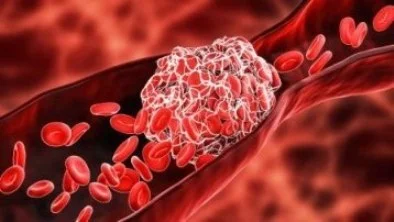 Thromboses et médicaments anticoagulants oraux