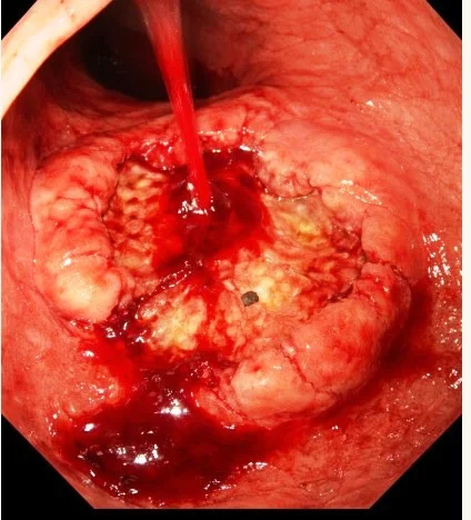ulcère gastrique qui saigne, endoscopie
