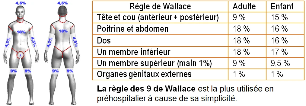 Brulures, règle des 9 de wallace