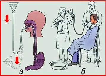 Lavage gastrique, technique médicale, intoxications