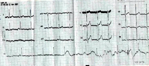 ECG tracé