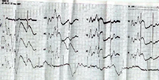 Tracé ECG électrocardiogramme