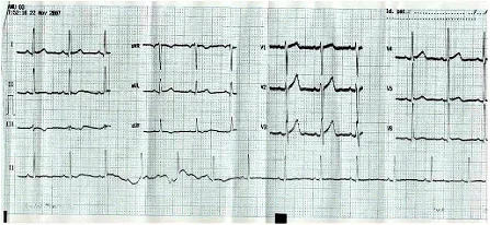 Rythme cardiaque ECG