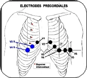 Position des électrodes ECG standard