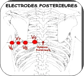 Position droites des électrodes ECG