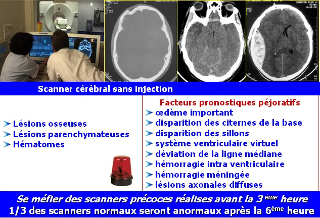 TDM traumatisme crânien Traumatisme crânien, indications du scanner