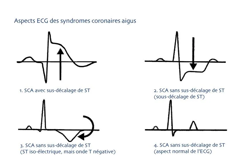 ecg dans le syndrome coronarien