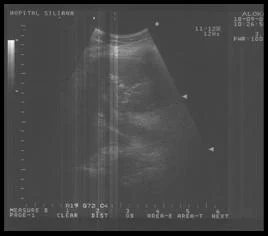Echographie
