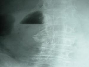 Pneumoperitoine