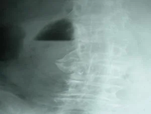 Pneumoperitoine