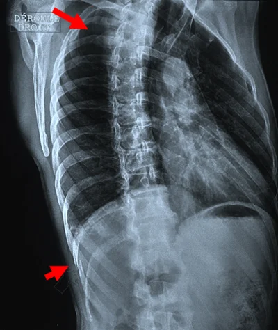 Radiographie thorax fracture de cote
