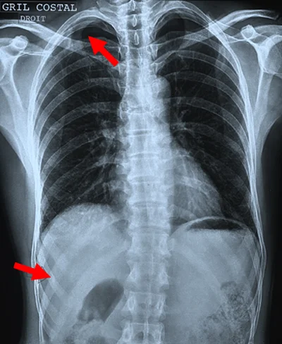 Radiographie thorax fracture costale