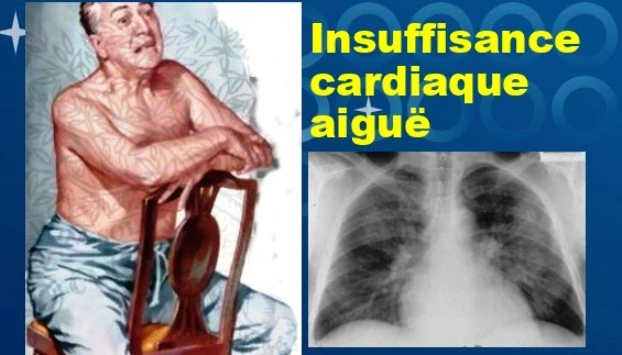 Orthopnée, signe d'insuffisance cardiaque aigu OAP