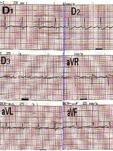 Tracé ECG