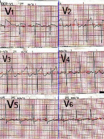 ecg