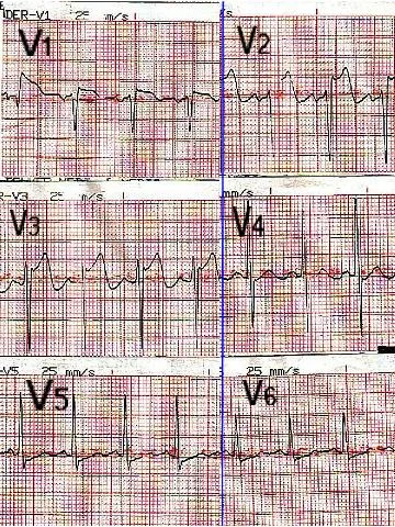 ECG électrocardiogramme