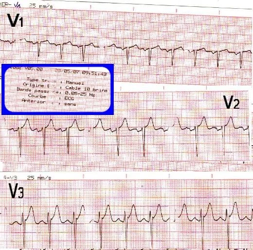 filtres ECG