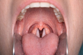 épiglotte, intubation trachéale