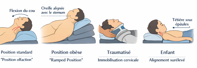 Intubation position du patient