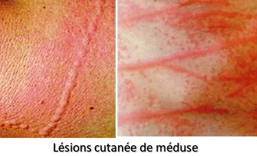 Lésions cutanées après piqures par méduse marine