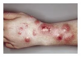infection à mycobacterium marinum infection cutanée par bactérie mycobacterium marinum