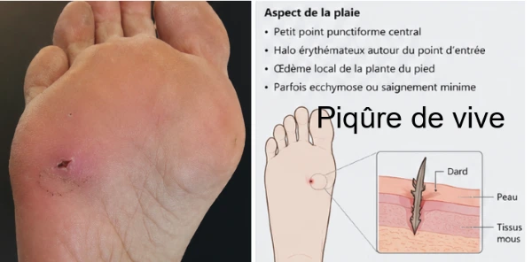 Piqure par poisson vive au pied, signes cutanées