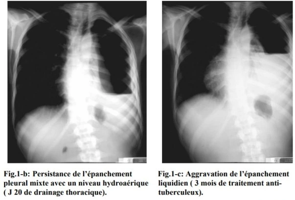 Radiographie pulmonaire avec des complications de tuberculose Radiographie pulmonaire avec des complications de tuberculose