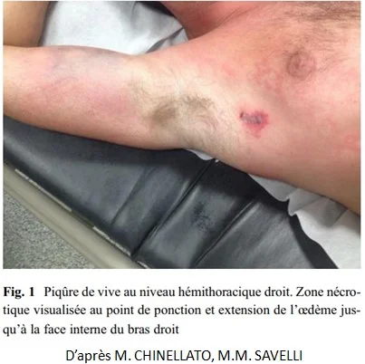 Lesions cutanées par piqure du poisson vive