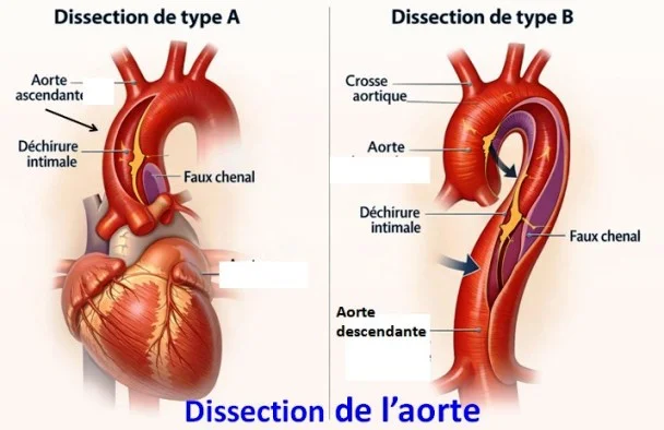 Type 1 et type 2 Dissection de l'aorte, type 1 et type 2